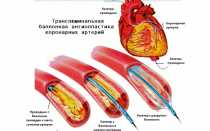 Как жить после стентирования сосудов сердца