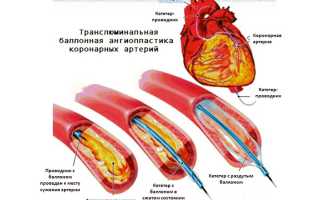 Как жить после стентирования сосудов сердца