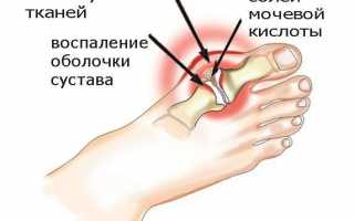 Правильно проводим чистку суставов от солей