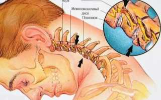 10 симптомов переломов шейных позвонков, последствия