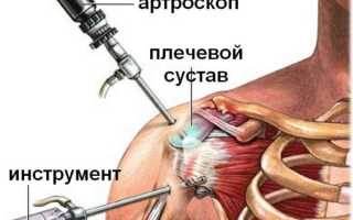 Реабилитация после артроскопии плечевого сустава и других сочленений