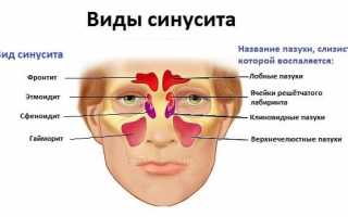 Чем отличается синусит от гайморита