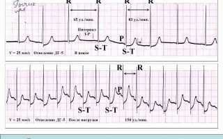 Кардиограмма перед медкомиссией, как сделать лучше