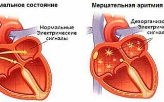 Мерцательная аритмия сердца: симптомы и лечение