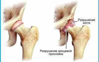 Как побороть серонегативный ревматоидный артрит?