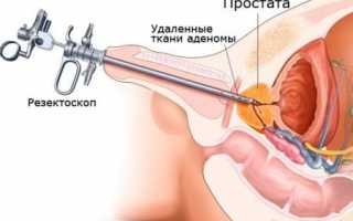 Кальцинаты в простате – 6 методов лечения