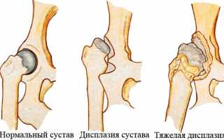 Клинические признаки дисплазии тазобедренного сустава у взрослых