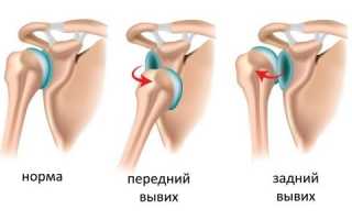 Как вылечить боли в плечевом суставе народными средствами?