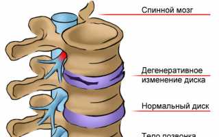 Все что нужно знать о шейно-грудном остеохондрозе