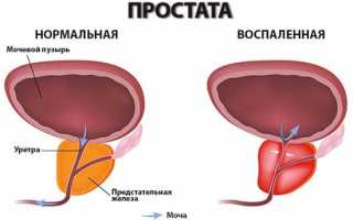 Симптомы воспаления простаты у мужчин и их проявления