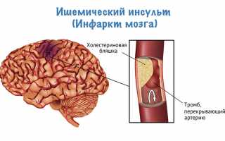 Как избежать ишемического инфаркта головного мозга