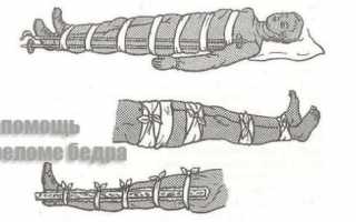 Оказание первой доврачебной помощи при различных переломах – базовые правила и инструкции