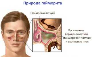 Как лечат гайморит