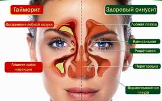 Симптомы гайморита – как вовремя распознать что у тебя гайморит