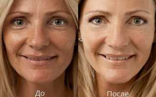 Озонотерапия для лица: описание процедуры и результаты