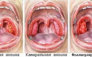 8 видов ангины. Инкубационный период и симптомы