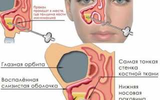 Пункция гайморовой пазухи – как делают прокол