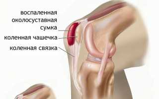 Какими лекарствами можно снять боль в коленях?