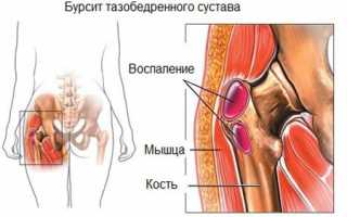 Что такое бурсит? Причины и лечение