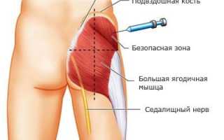 Как правильно делать уколы внутримышечно