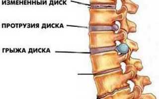 Хирургические и консервативные методы для лечения остеохондроза
