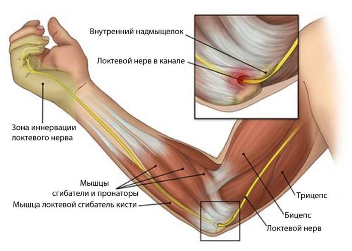 Артрит локтевого сустава