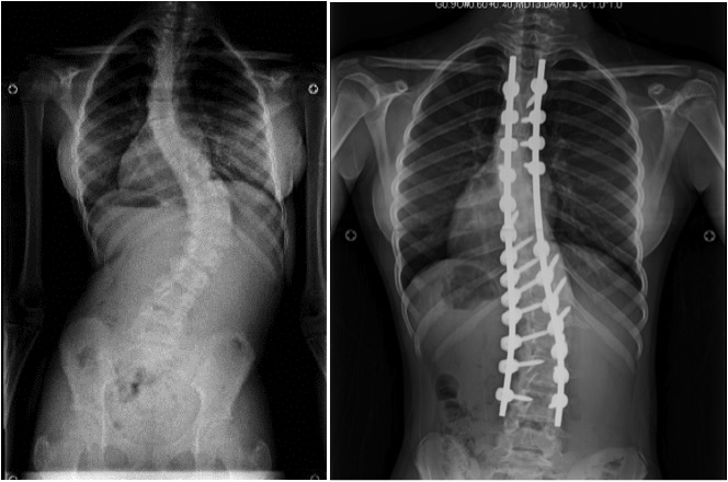Диагностика искривления позвоночника Искривление позвоночника