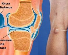 Киста Бейкера