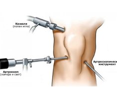 Артроскопические инструменты