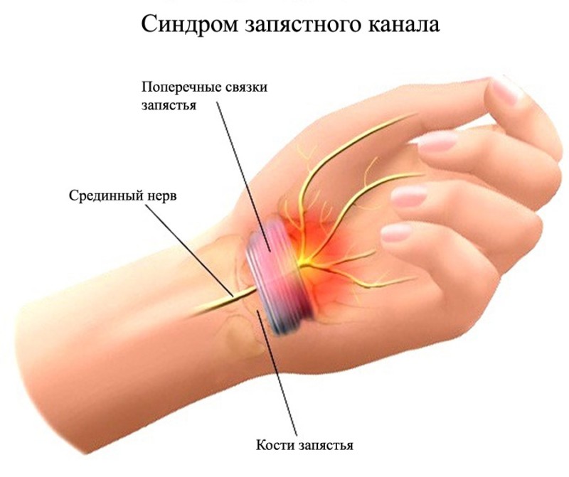 Туннельный синдром запястья