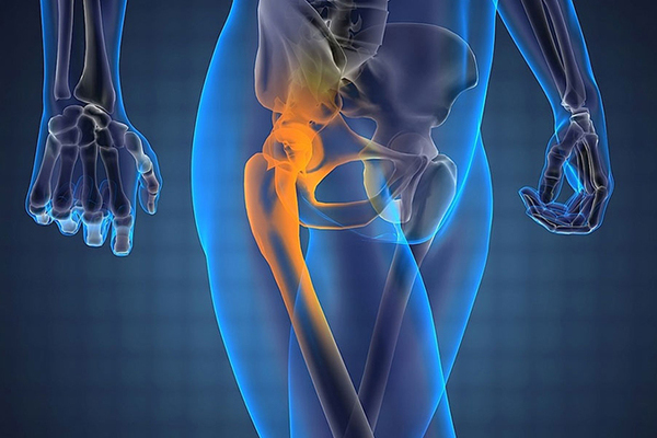 Операция на тазобедренный сустав: показания Операция на тазобедренный сустав