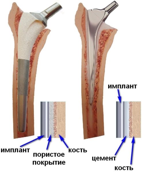 Эндопротезирование