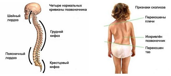 Лечение сколиоза позвоночника