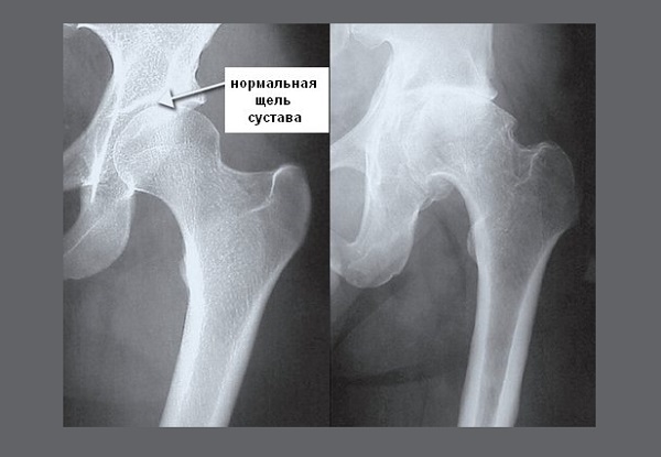 Лечение коксартроза