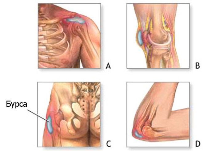 Особенности и симптомы бурсита Симптомы бурсита
