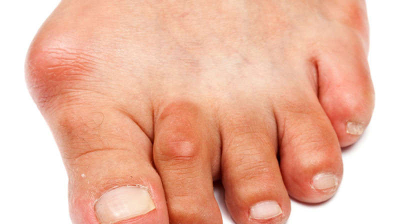 Особенности и симптомы бурсита Симптомы бурсита