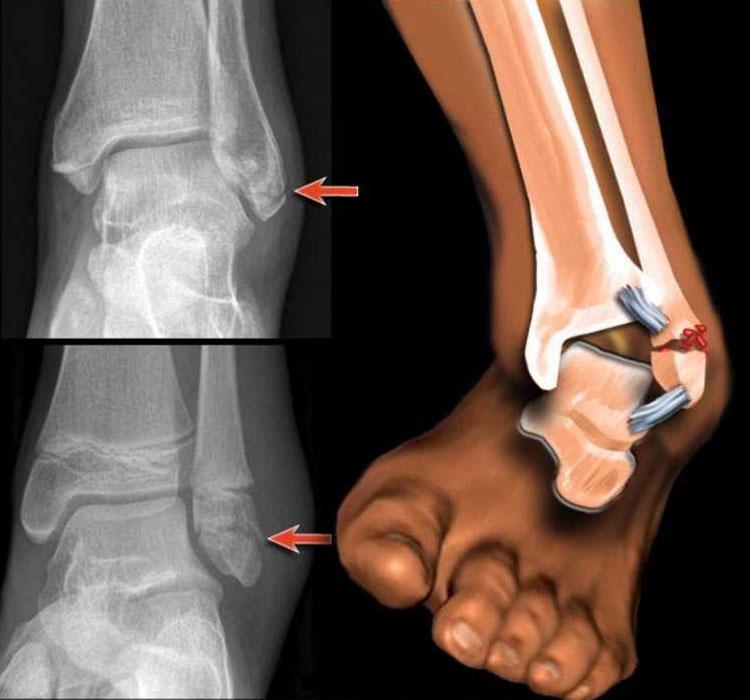 Вывих ноги: оказание первой помощи Вывих ноги