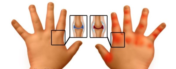 Особенности артрита у детей Артрит у ребенка