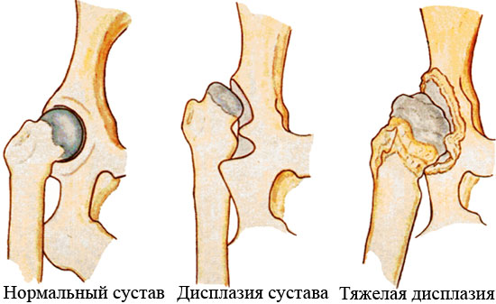 Дисплазия тазобедренного сустава у взрослых