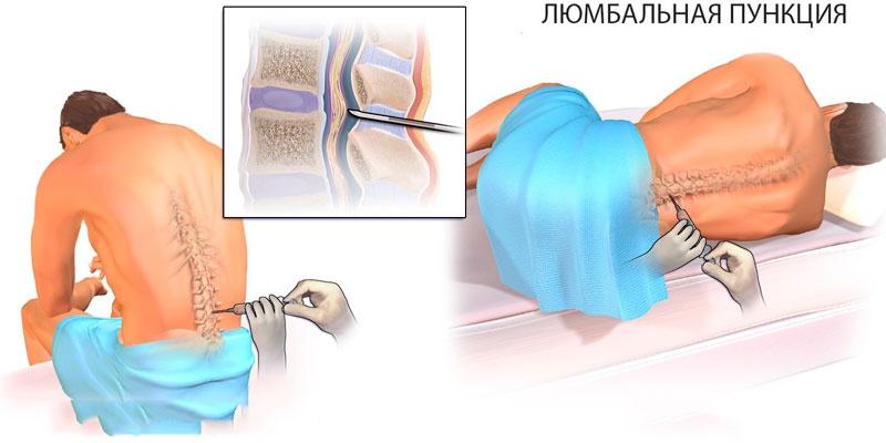 Пункция спинного мозга