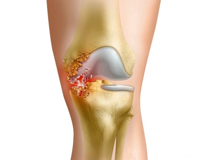 Симптомы бурсита, в чем опасность Симптомы бурсита