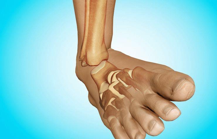 Вывих ноги: причины возникновения Вывих ноги