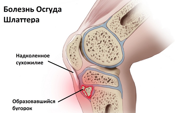 Болезнь Шляттера коленного сустава
