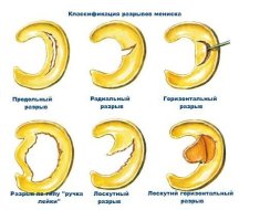 Классификация разрывов мениска