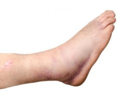 Проявление артрита голеностопа