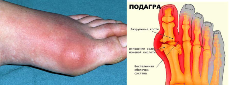 Подагра в домашних условиях