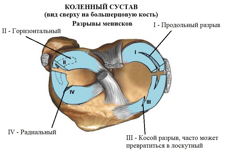 Разрыв мениска коленного сустава как лечить отзывы. Разрыв мениска коленного сустава как лечить отзывы