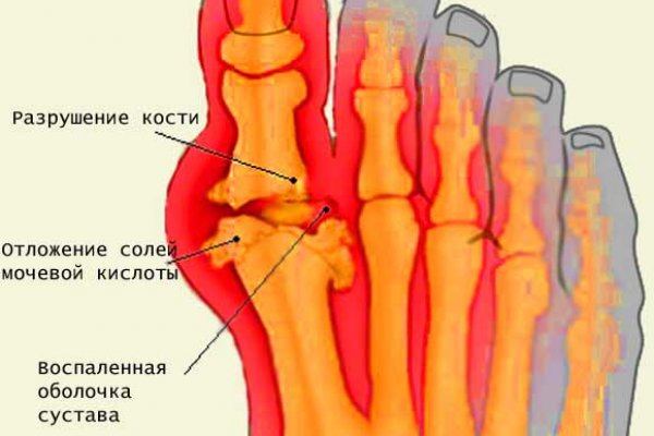 Обострение подагры