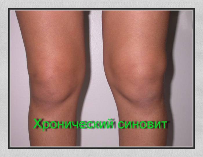 Синовит