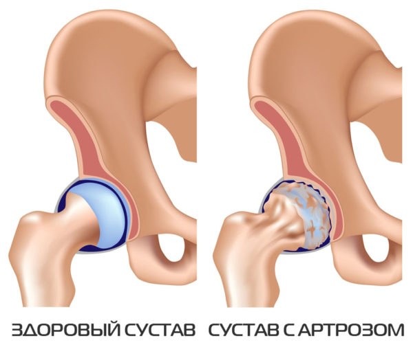 Препараты для лечения коксартроза